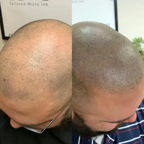 Scalp micropigmentation before and after