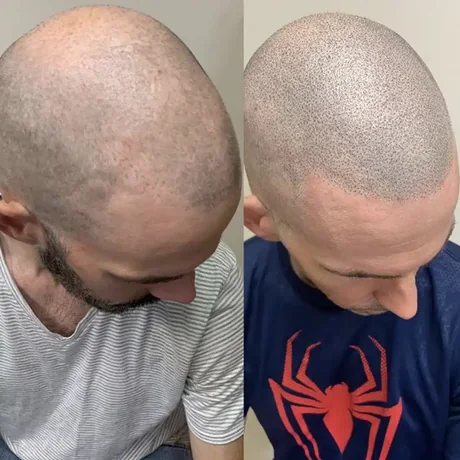 Scalp micropigmentation before and after — full scalp