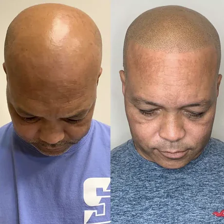 Follicle replication treatment before and after