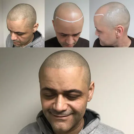 Follicle replication treatment results