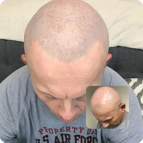 Pattern baldness treated with scalp micropigmentation