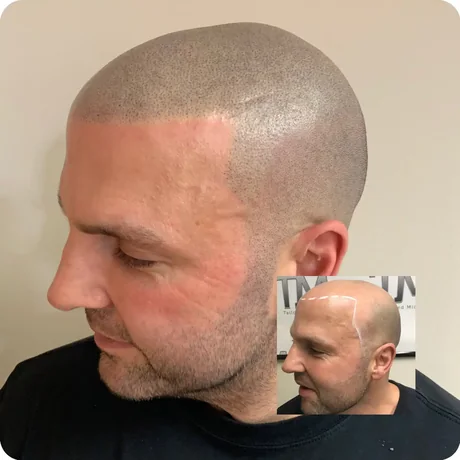 Alopecia treated with scalp micropigmentation — before and after