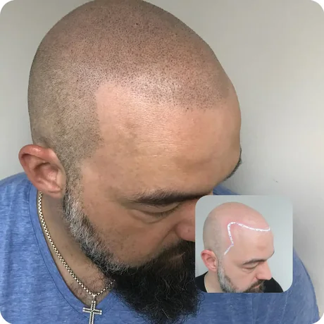 Non-surgical hair loss treatment before and after