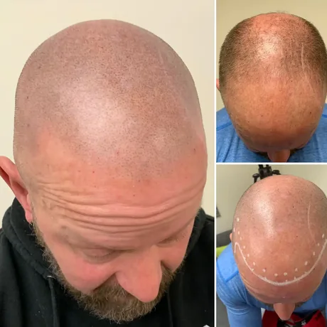 Scalp micropigmentation success — before and after