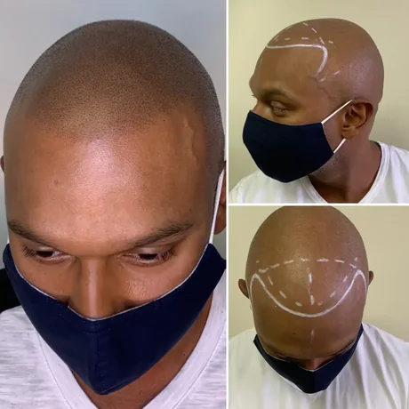 Hairline restoration with scalp micropigmentation