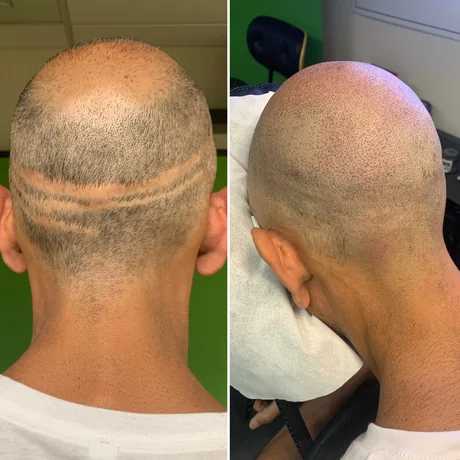 Hair transplant strip scar camouflaged with scalp micropigmentation