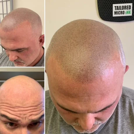 Scalp micropigmentation before and after in the Allentown studio
