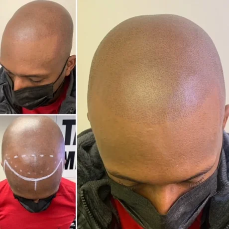 Hairline mapped and treated with scalp micropigmentation