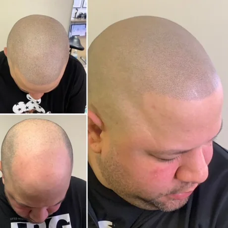 Scalp micropigmentation before and after