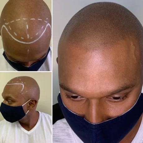 Scalp micropigmentation before and after — hairline design