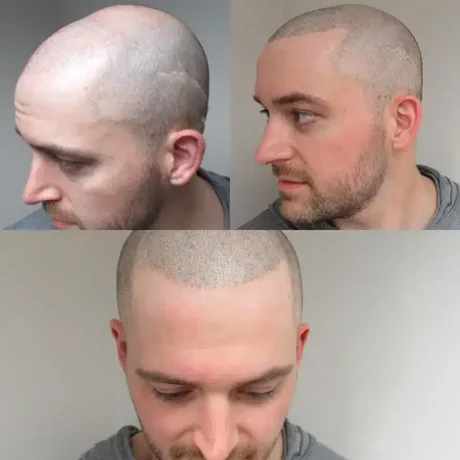Scalp micropigmentation from three angles — before and after