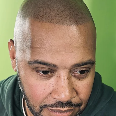 Scalp micropigmentation result — front hairline