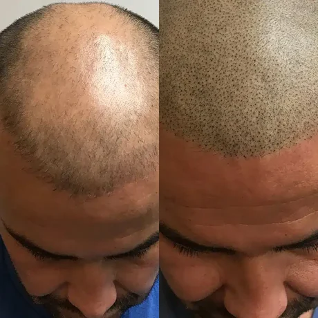 Scalp micropigmentation before and after — hairline restoration