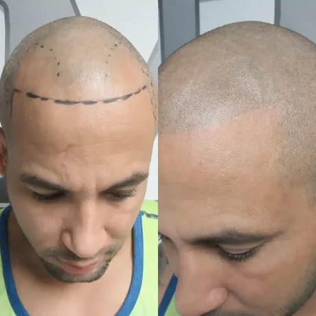 Receding hairline before and after scalp micropigmentation