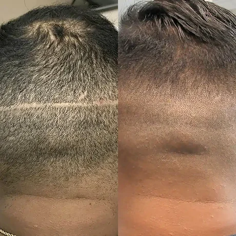 Surgical strip scar blended with scalp micropigmentation