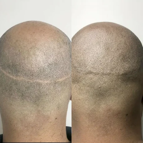Scar camouflaged with scalp micropigmentation — before and after