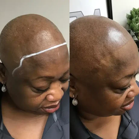 Scalp micropigmentation for a female client — before and after