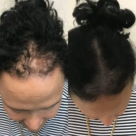 Female thinning treated with scalp micropigmentation